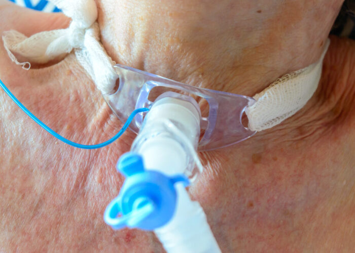 Tracheostoma: Rückschritt oder Schritt zurück zur Normalität?